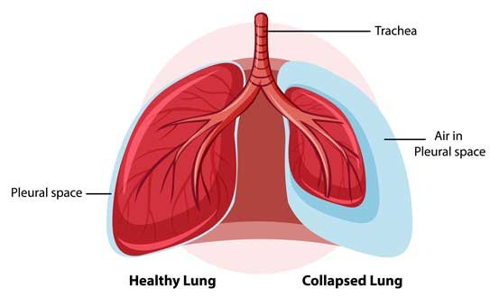 Collapsed Lung - Pneumothorax Treatment in London