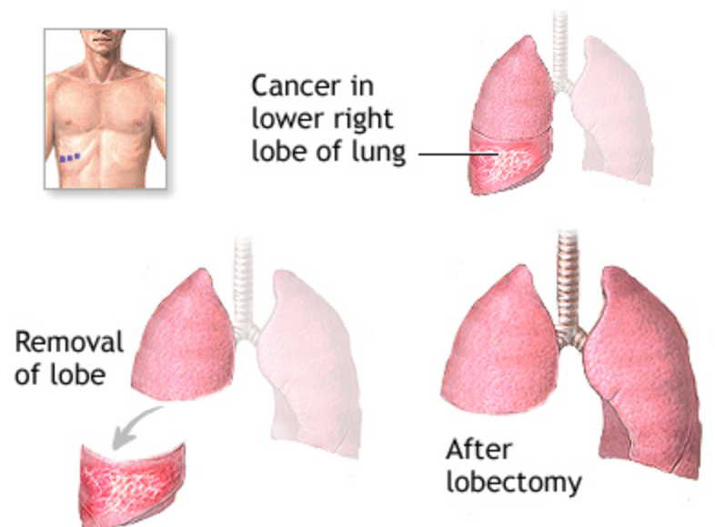 Pulmonary lobectomy diagram