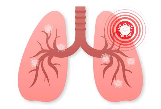 Severe Chest Infection Empyema Treatment in London