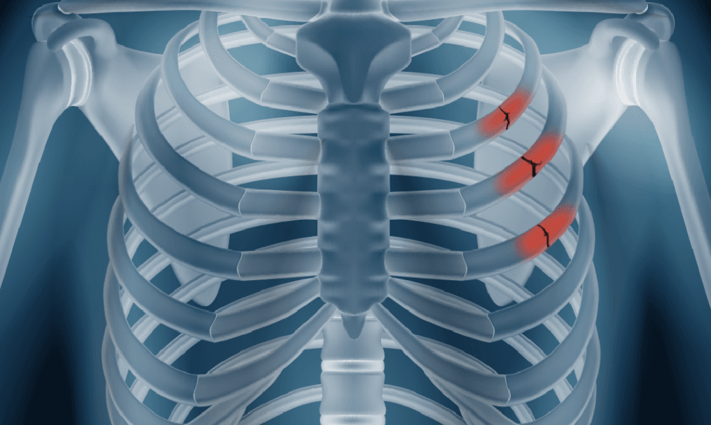 Understanding Rib Fractures