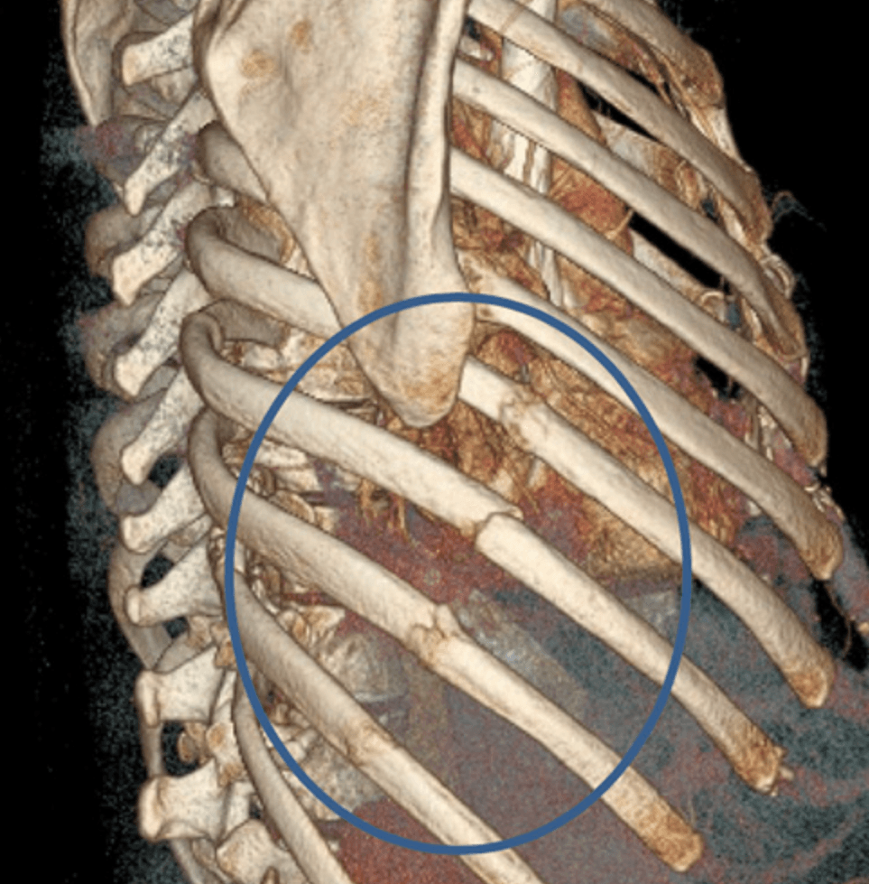 Three-dimensional reconstruction of rib fractures on CT.