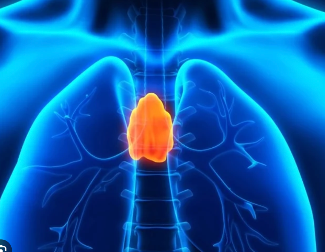 Graphic of a thymoma